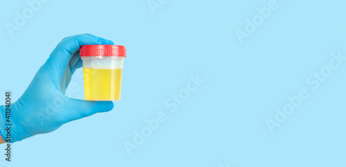 Hand holding urine sample container for medical urinalysis