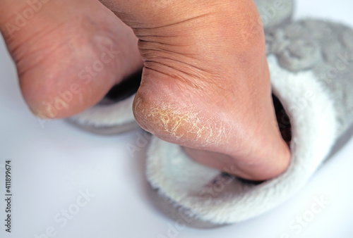 A woman foot in winter slipper with dried skin problem. Focus on deep crack dry heel on the foot with bad skin is covered with rough cracks skin.