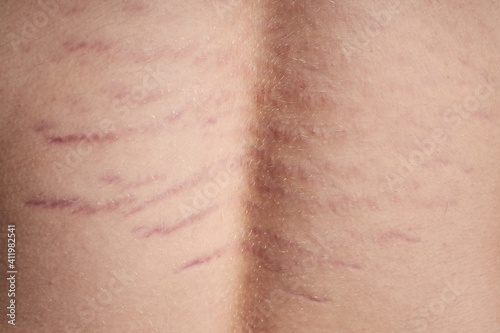 Close up view of the back with striae distensae (striae rubrae) on the skin. The concept of impaired skin elasticity during puberty