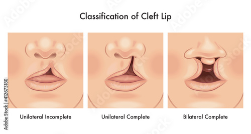 Medical illustration shows a classification of cleft lip, with annotations.