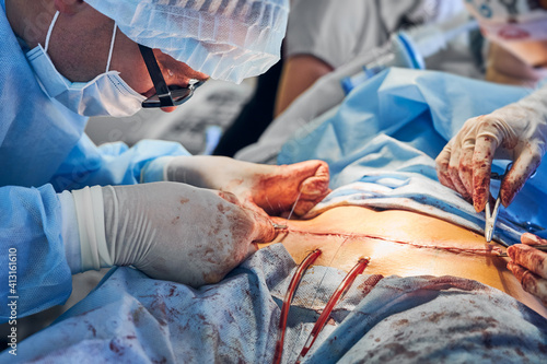 Close up of male surgeon in sterile gloves placing sutures after tummy tuck surgery. Man doctor performing abdominal plastic surgery in the hospital. Concept of abdominoplasty and cosmetic surgery.