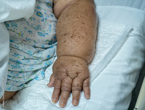 Lymphatic edema in a elderly female due to axillary emptying for breast cancer