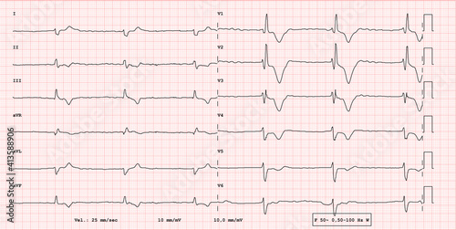 ECG example of a pathological 12-lead rhythm, atrial fibrillation with total block