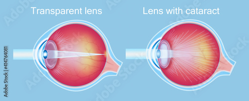 Cataracts and healthy eye detailed structure.