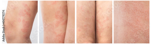 Panel Collage about acute atopic dermatitis on the legs of a child is a dermatological disease of the skin. Large, red, inflamed, scaly rash on the legs. Legs of a teenager with severe atopic eczema.