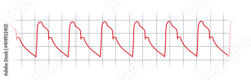 Invasive Blood Pressure Waveform - Arterial pulse