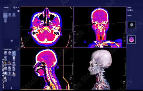 Colorful of CT angiography of the brain or CTA brain comparison Axial , Coronal and Sagittal view and 3D rendering on the screen.