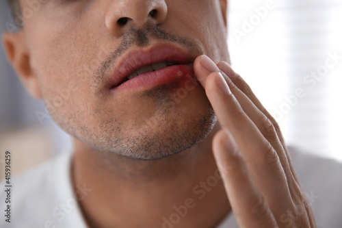 Man with herpes touching lips against blurred background, closeup