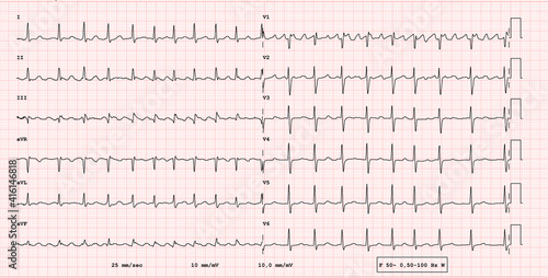 ECG example of a pathological 12-lead rhythm, atrial flutter