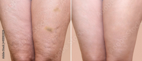 Thighs of a woman with cellulite and bruises before and after medical treatment