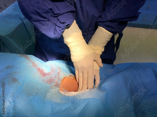 Scrub nurse press on patient’s groin for stop bleed at puncture site during cardiac catheterization. 