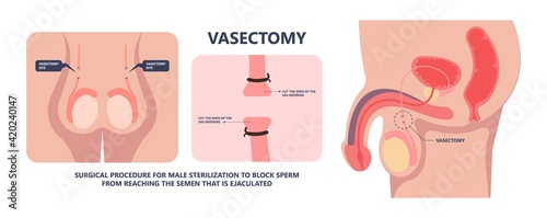 in vitro fertilization IVF semen test sample sperm count type Male biopsy fertility collect Low Poor Zero head anatomy midpiece tail birth control blocked defect abnormal ejaculate vas Non dry