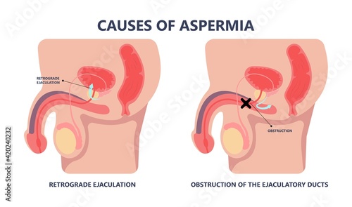 in vitro fertilization IVF semen test sample sperm count type Male biopsy fertility collect Low Poor Zero head anatomy midpiece tail birth control blocked defect abnormal ejaculate vas Non dry