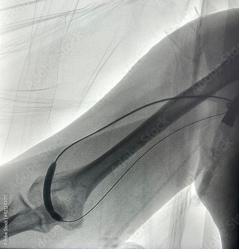 Angiogram shown balloon inflated in hemodialysis arteriovenous fistula (AVF) during Endovascular intervention.