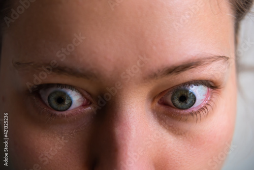 Macro closeup of young woman face with Grave's disease hyperthyroidism symptoms of ophthalmopathy bulging eyes proptosis edema