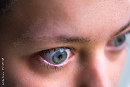 Macro closeup profile portrait of young woman face with Grave's disease hyperthyroidism symptoms of ophthalmopathy bulging eyes and proptosis edema