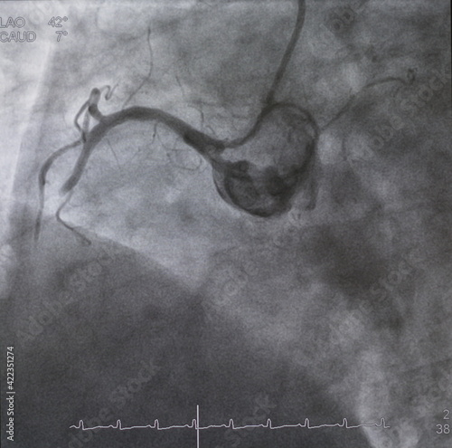 Coronary angiogram (CAG) was performed total occlusion at right coronary artery (RCA).