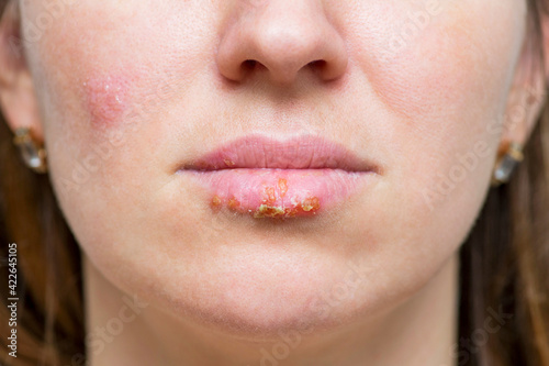 Manifestation of the herpes virus on the lips closeup. Part of a young woman's face with a virus herpes on lips