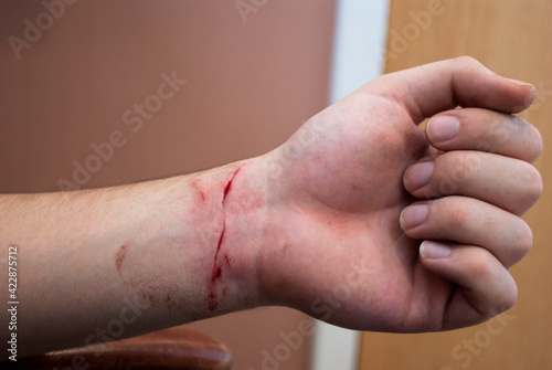 Close up of a cut on a person's wrist 