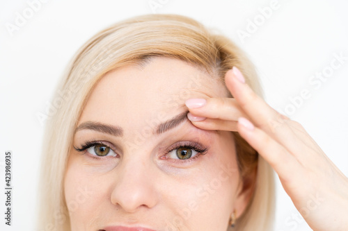 woman shows drooping eyelid for plastic surgery