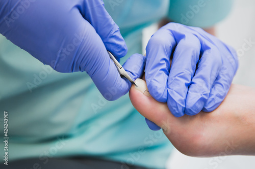  Professional pedicure using a corrective brace. A podiatrist doctor treats a patient's ingrown toenail.