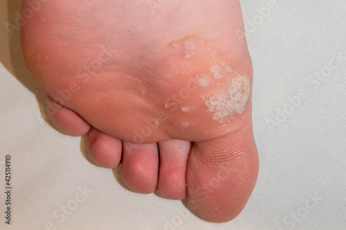 Sole of foot showing mosaic plantar wart and other verrucas including the black spot clotted blood vessel centres