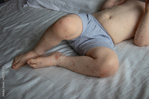 A toddler boy with rash infected by Roseola Disease. Roseola is a contagious illness that’s caused by a virus. It shows up as a fever followed by a signature skin rash.