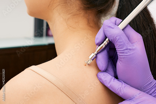 Close up dermatologist removing a mole on a woman's back using a laser knife. Painless removal of benign skin lesions at medical center