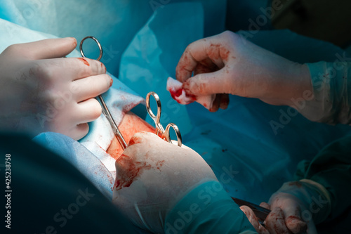 The bloody hands of surgeons in sterile gloves work with a medical instrument during a surgical operation.