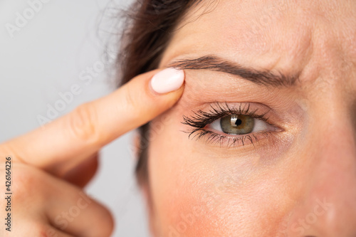 Close-up portrait of Caucasian middle-aged woman pointing to the wrinkles on the upper eyelid. Signs of aging on the face