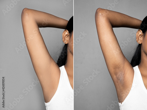 Asian woman with underarm before and after skincare cosmetology armpits epilation treatment concept. black armpit in a woman.