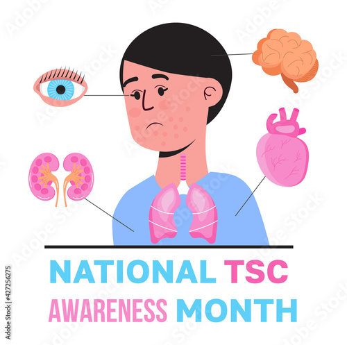 Tuberous sclerosis awareness month is celebrated in USA. Patient with rash, pimples are shown. Blue ribbon vector. Health care illustration for banner, web