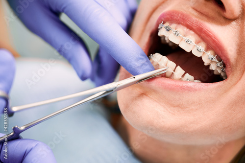 Close up of orthodontist hands in blue gloves using dental forceps while putting ligature wire on female patient teeth. Woman with metal braces on teeth receiving orthodontic treatment in clinic.