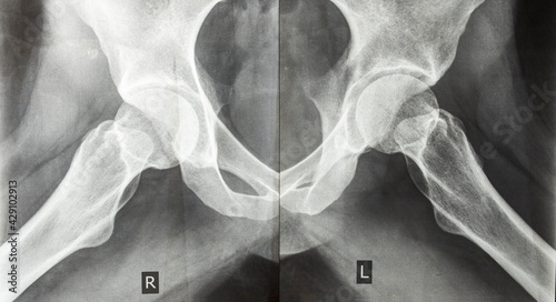 .X-ray picture of human hip joints. Bones x-ray. Traumatology