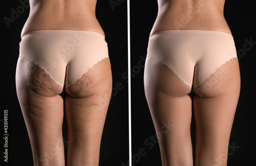 Collage with photos of woman before and after anti cellulite treatment on black background,