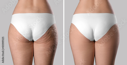 Collage with photos of woman before and after anti cellulite treatment on grey background,