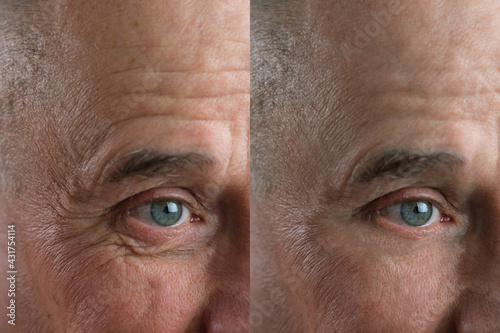 Before and after cosmetic operation. close-up of eyes and forehead of old man, senior with wrinkles on his face in two versions, wrinkles on face, overhang, concept of cosmetic anti-aging procedures,