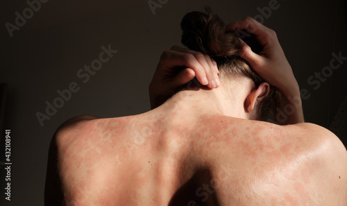 Close-up woman touches herself. Neck, back, spine. Psoriasis skin, eczema, rash and other skin diseases. A woman hides her face, she is ashamed of her autoimmune genetic disease. Imperfect beauty. 