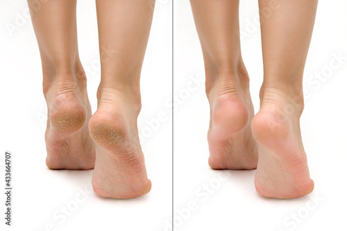 Feet with dry skin before and after treatment. comparison of a dry heel and a healthy foot. keratinized skin on the foot. treatment of corns