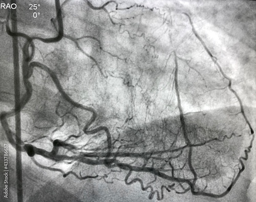 coronary angiogram showed right coronary artery (RCA) given collateral to left anterior descending artery (LAD) that had chronic total occlusion (CTO).