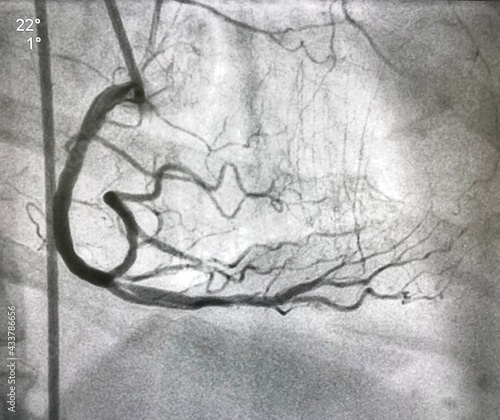 coronary angiogram showed right coronary artery (RCA) given collateral to left anterior descending artery (LAD) that had chronic total occlusion (CTO).