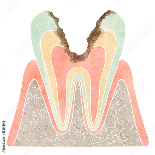 虫歯になった歯の断面（C3）