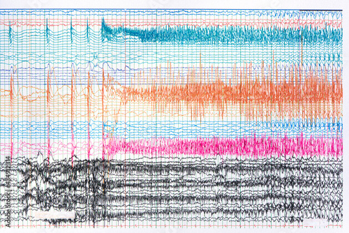 Photograph of ictal EEG during seizure