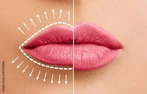 Lip augmentation concept. Woman lips before and after lip filler injections
