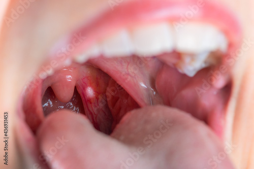 Close up on a canker sores. Inflammation of oral cavity. Very painful aphthae on uvula or soft palate. Really disturbing mouth ulcers. Anatomy of a inflamed buccal cavity. Reddened buccal mucosa.