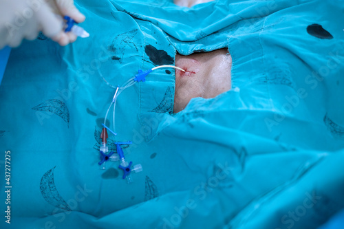 anesthetist setting central venous catheter to patient before open heart surgery