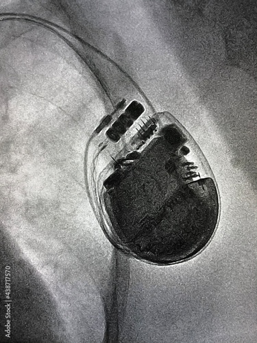 X ray image during permanent pacemaker implantation procedure. 
