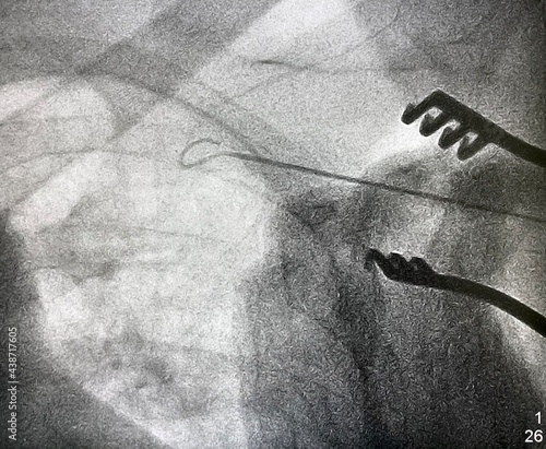 X ray image during permanent pacemaker implantation procedure. 