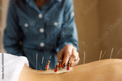 Unrecognizable woman acupuncturist working with moza, burning mugwort close to skin on back, using acupuncture needles to enhance qi movement. Energy, health, vitality and wellness concept