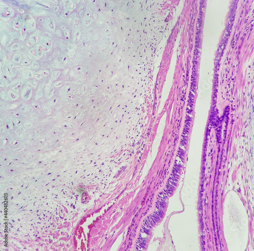 Photo of pulmonary hamartoma, focus on cartilage, magnification 200x, photo under microscope